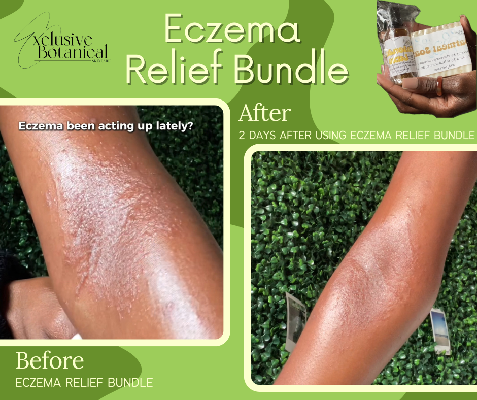 Eczema Relief Bundle