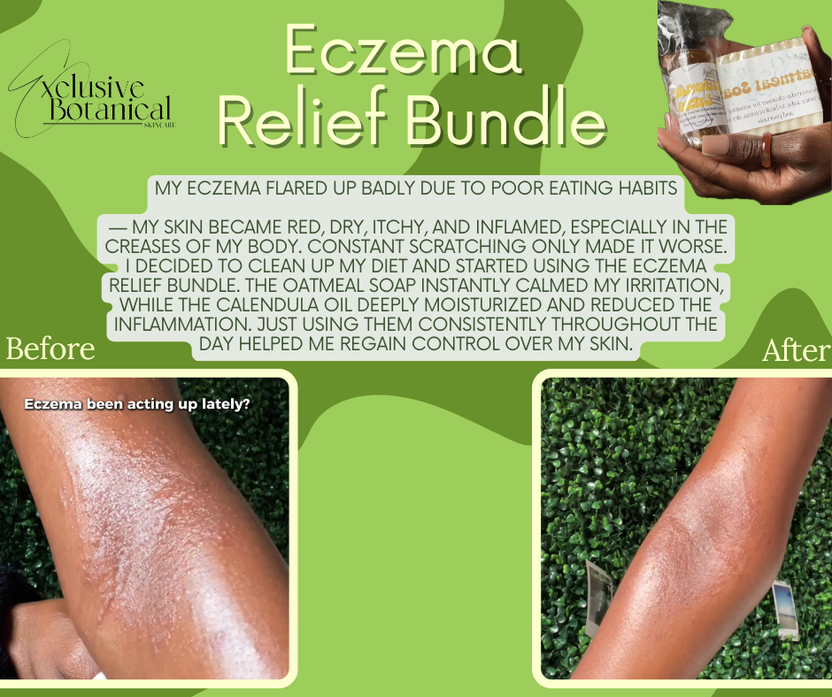 Eczema Relief Bundle
